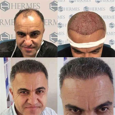 hermest hair transplant reviews.